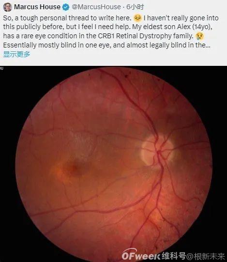 马斯克脑机接口新突破：视觉芯片助力失明复明(图1)