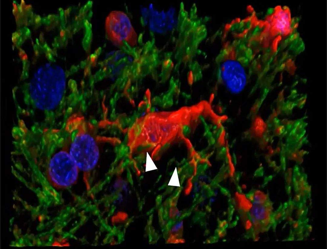 科学家发现阿尔茨海默病、血管性失智的新病因(图7) 科学家发现阿尔茨海默病、血管性失智的新病因(图7)