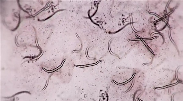 新研究：寄生虫或能控制2型糖尿病