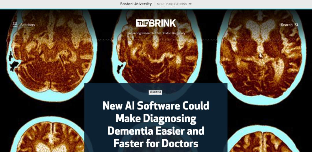 新的人工智能软件可以让医生更容易、更快地诊断失智症(图1)