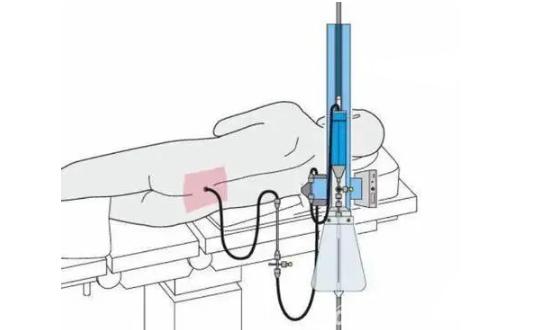 光纤压力传感器检测脑脊液压力(图1) 光纤压力传感器检测脑脊液压力(图1)