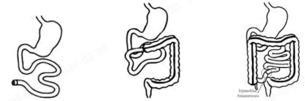 TidesPro | 国内首个GLP-2类似物替度格鲁肽获NMPA批准(图4) TidesPro | 国内首个GLP-2类似物替度格鲁肽获NMPA批准(图4)